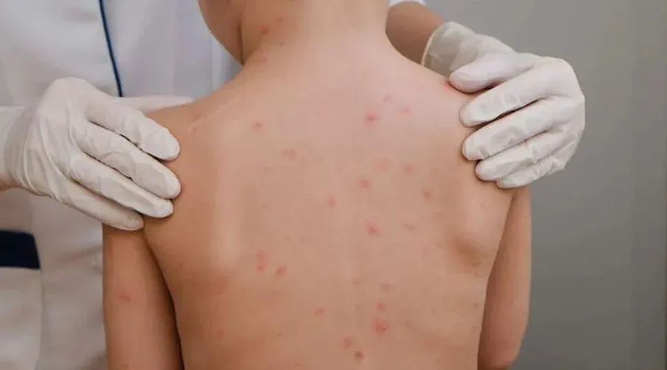 Alagoas: União dos Palmares confirma caso de meningite tipo B