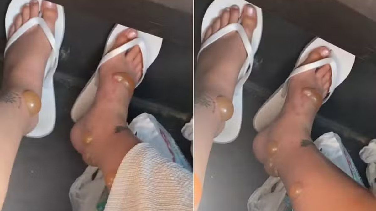 Mulher viraliza com impressionante reação a picadas de insetos durante lua de mel