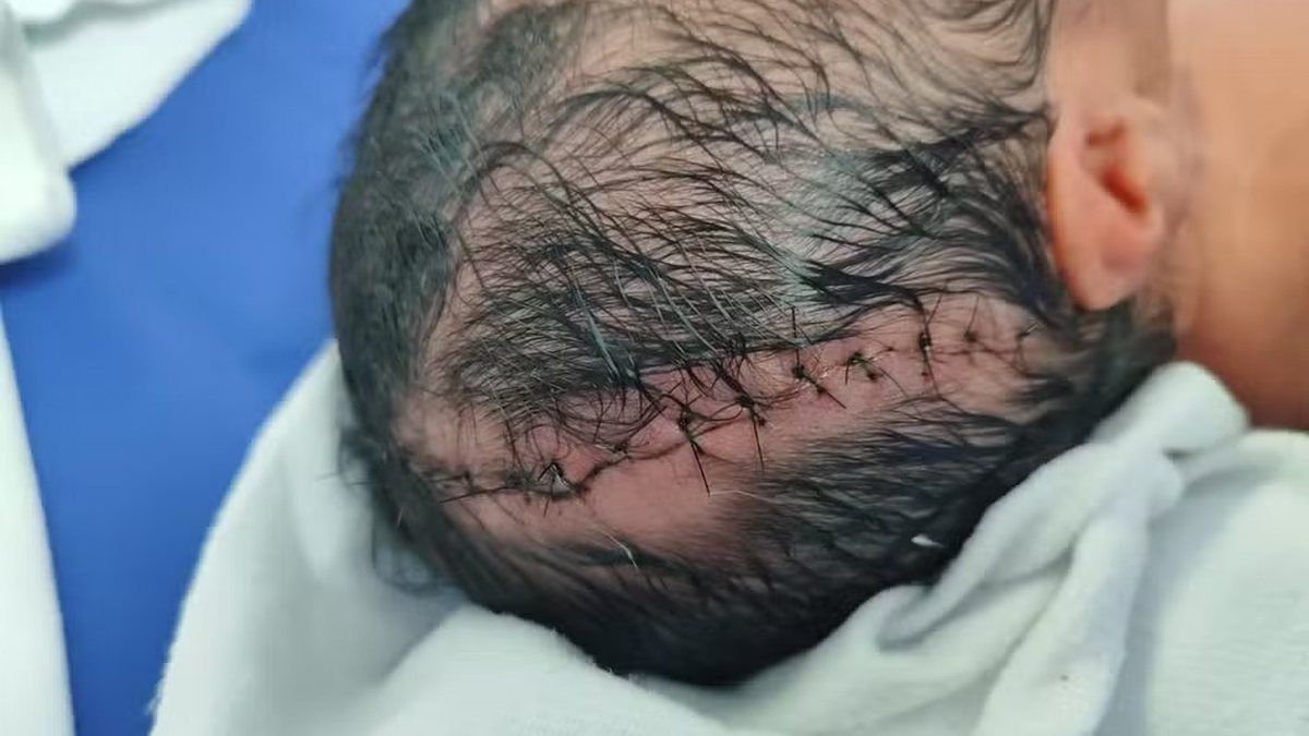 Bebê sofre corte na cabeça em cesárea e precisa de 14 pontos: "Só consegui ver meu filho no dia seguinte"