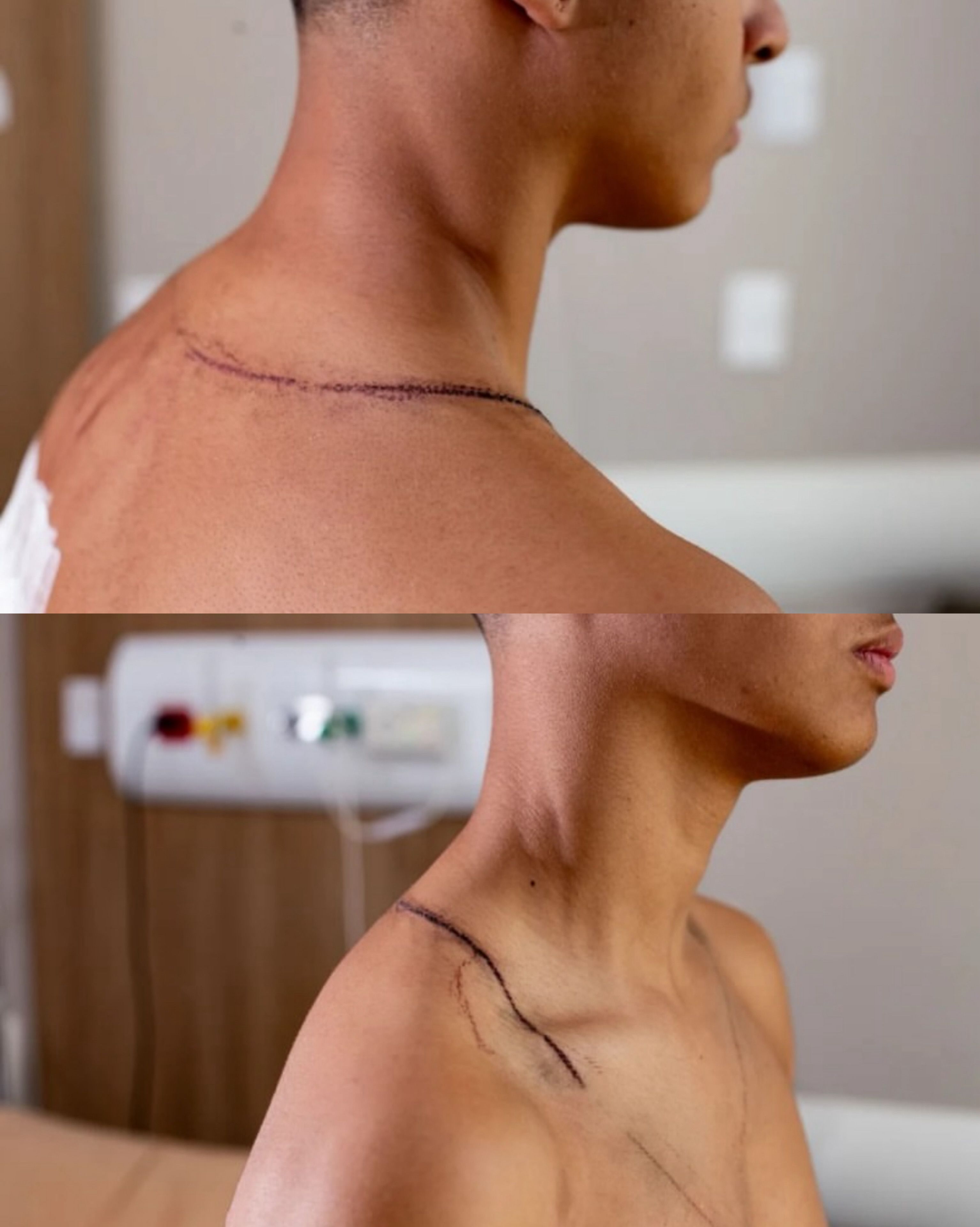 Adolescente atingido por raio durante ato em Brasília recebe alta hospitalar